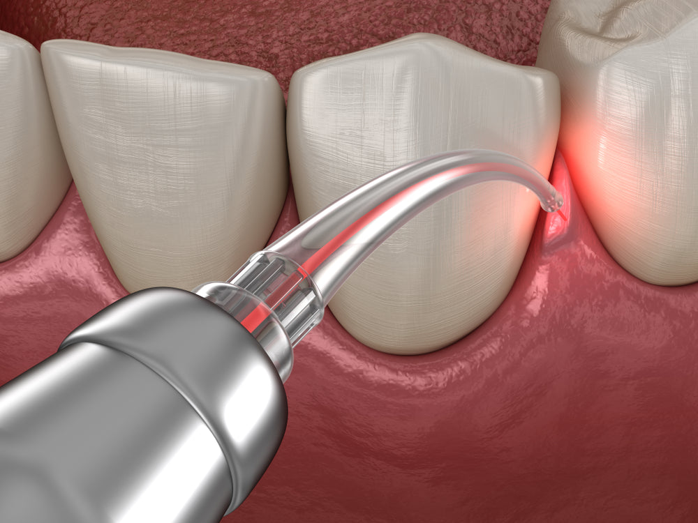 What Are the Benefits of Laser Technology for the Dental Industry?